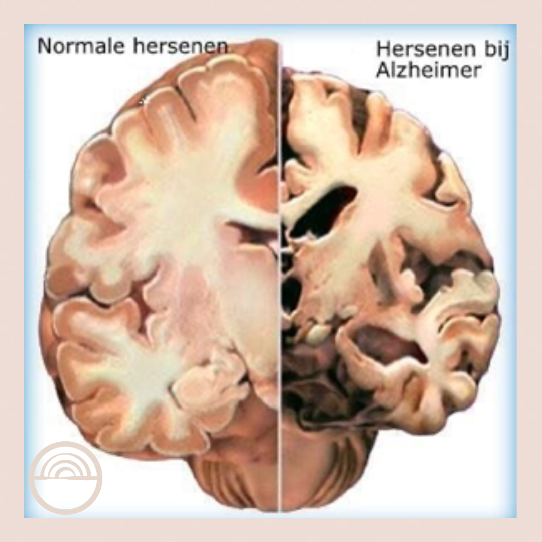 hersenen bij alzheimer versus normale hersenen
